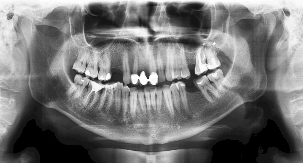 Por que o raio-X panorâmico não é indicado para realizar implantes dentários?