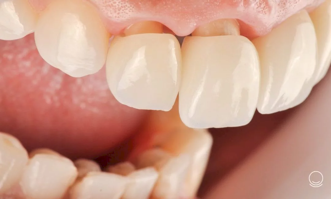 Lentes de contato dental: são indicadas para quem tem bruxismo?